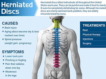 Herniated-Discs chronic back pain